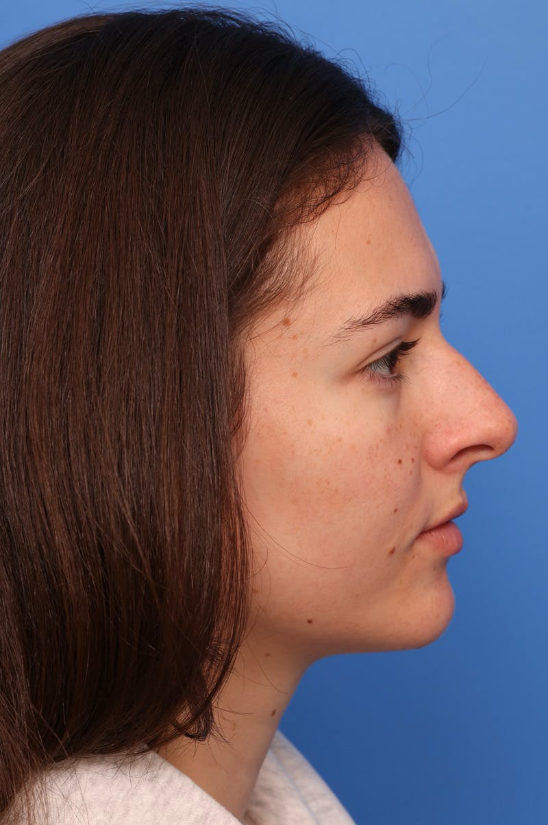 Rhinoplasty Before & After Gallery - Patient 228843 - Image 5