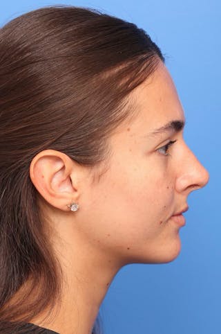 Rhinoplasty Before & After Gallery - Patient 228843 - Image 6