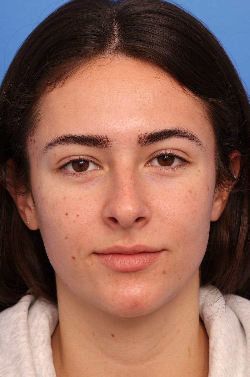 Rhinoplasty Before & After Gallery - Patient 228843 - Image 7