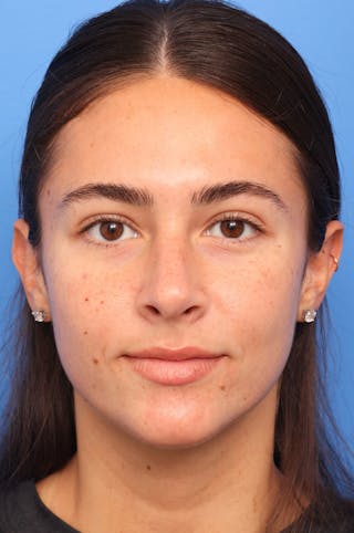 Rhinoplasty Before & After Gallery - Patient 228843 - Image 8