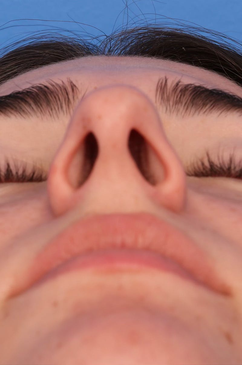 Rhinoplasty Before & After Gallery - Patient 228843 - Image 9