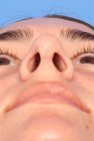 Rhinoplasty Before & After Gallery - Patient 228843 - Image 10
