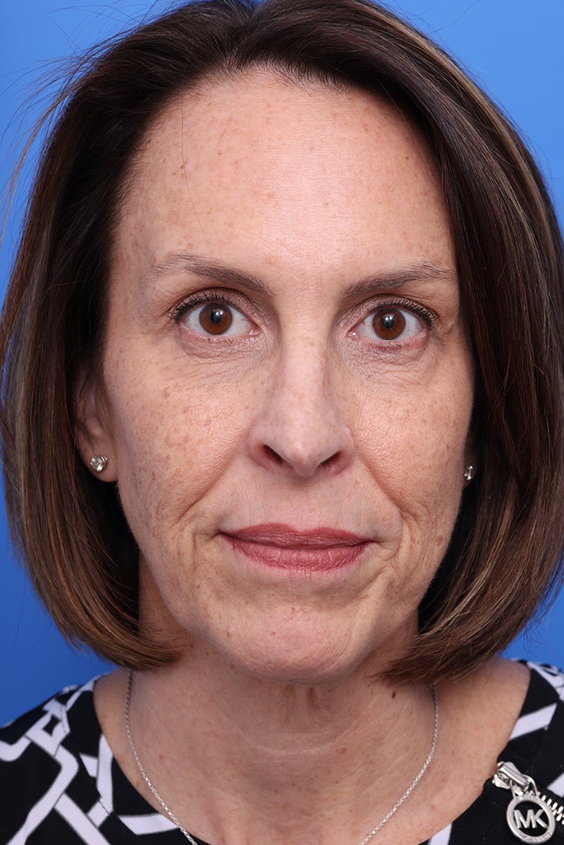 Laser Skin Resurfacing Before & After Gallery - Patient 110267 - Image 1