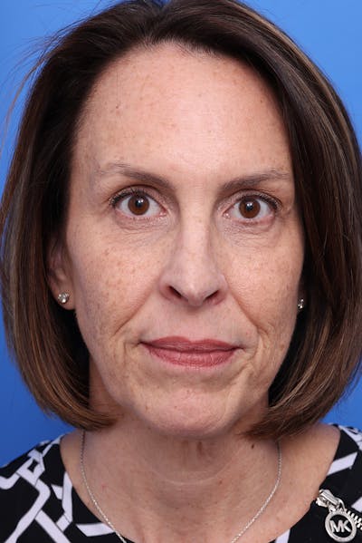 Laser Skin Resurfacing Before & After Gallery - Patient 110267 - Image 1