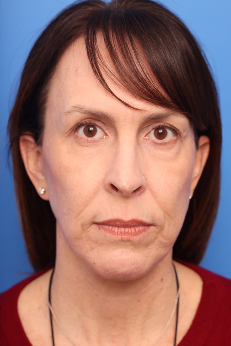Laser Skin Resurfacing Before & After Gallery - Patient 110267 - Image 2