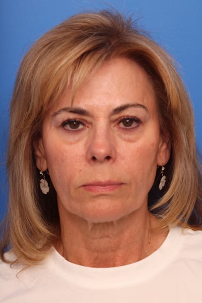 Deep Plane Facelift Before & After Gallery - Patient 280839 - Image 1