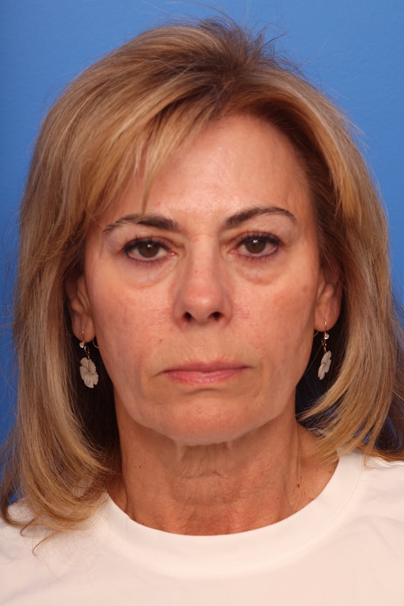 Deep Plane Facelift Before & After Gallery - Patient 280839 - Image 1