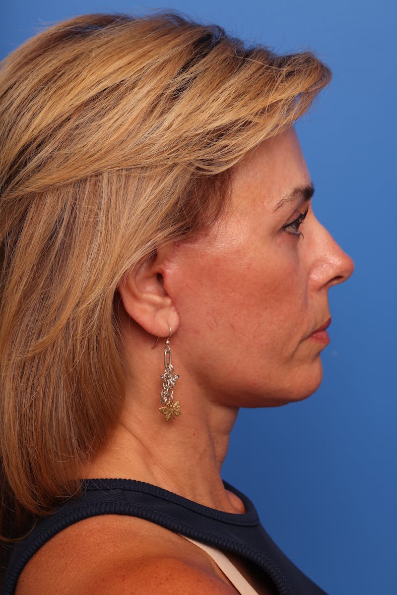 Deep Plane Facelift Before & After Gallery - Patient 280839 - Image 8