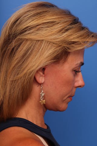 Deep Plane Facelift Before & After Gallery - Patient 280839 - Image 10