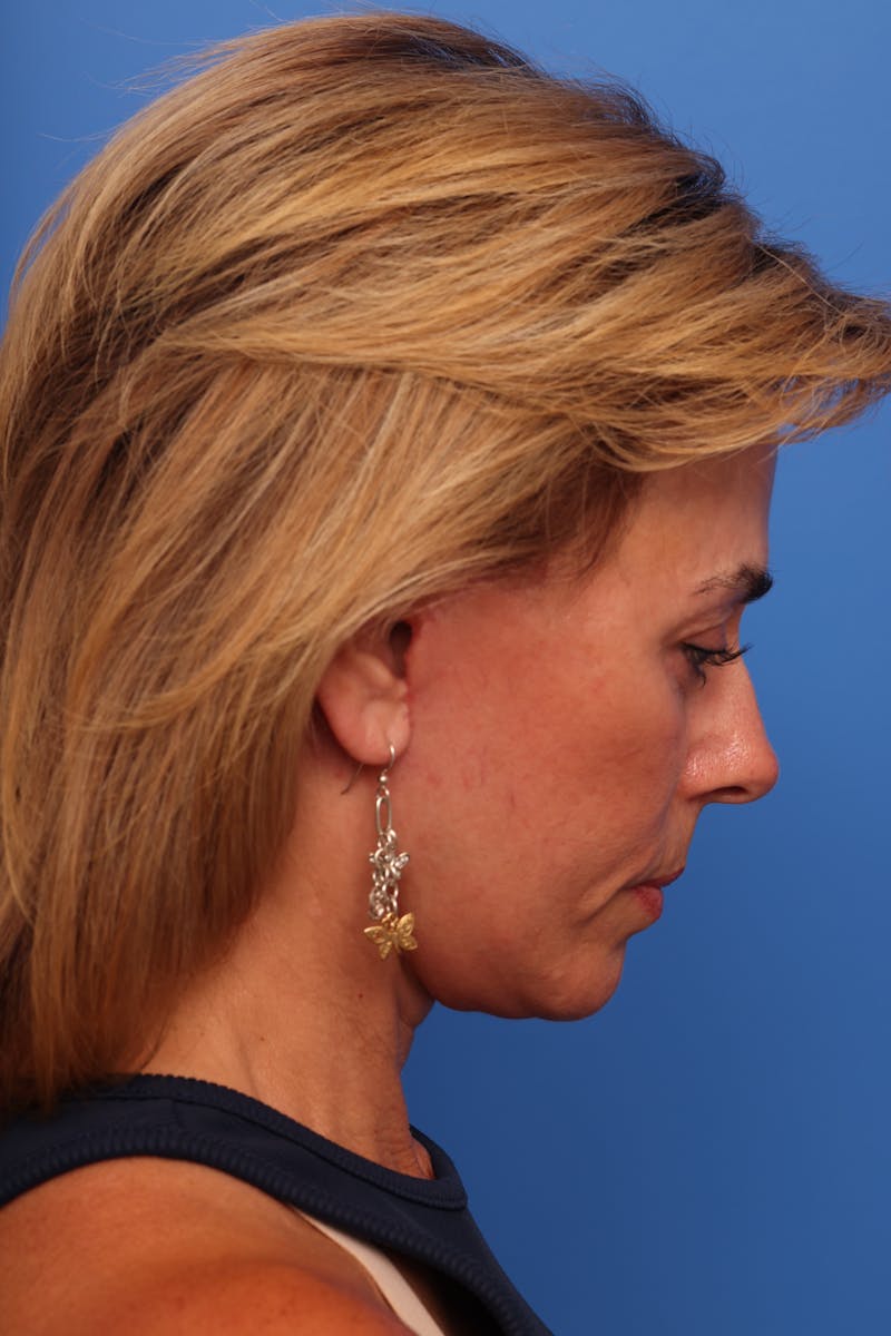 Deep Plane Facelift Before & After Gallery - Patient 280839 - Image 10
