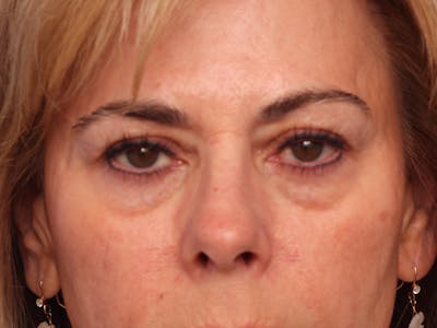 Lower Eyelid Lift Before & After Gallery - Patient 134821 - Image 1