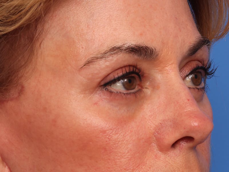 Lower Eyelid Lift Before & After Gallery - Patient 134821 - Image 4