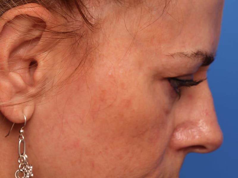 Lower Eyelid Lift Before & After Gallery - Patient 134821 - Image 7
