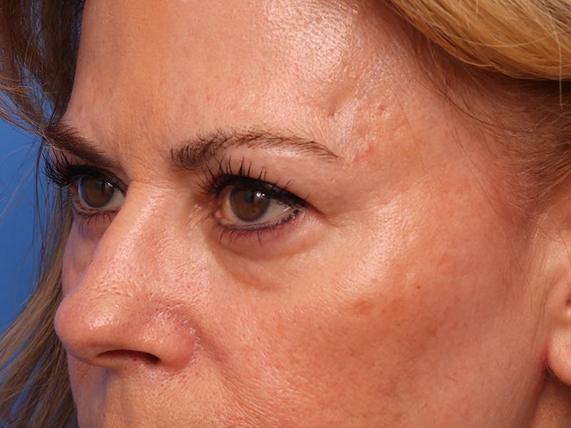Lower Eyelid Lift Before & After Gallery - Patient 134821 - Image 9