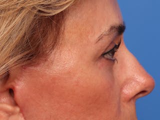 Lower Eyelid Lift Before & After Gallery - Patient 134821 - Image 6