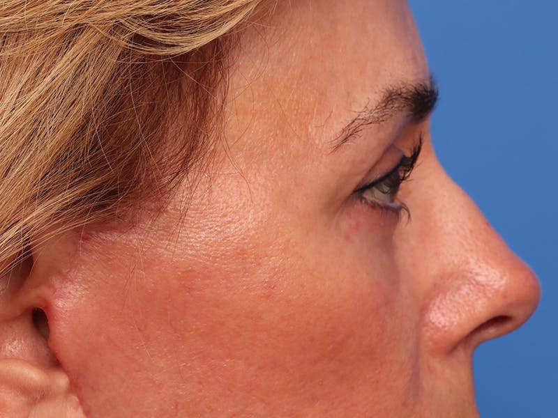 Lower Eyelid Lift Before & After Gallery - Patient 134821 - Image 6