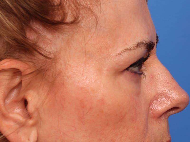 Lower Eyelid Lift Before & After Gallery - Patient 134821 - Image 5