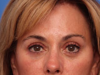 Brow Lift / Forehead Lift Before & After Gallery - Patient 496336 - Image 2