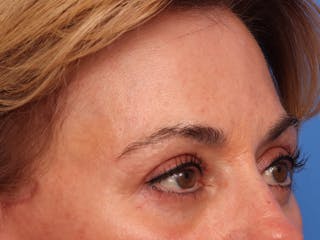 Brow Lift / Forehead Lift Before & After Gallery - Patient 496336 - Image 4