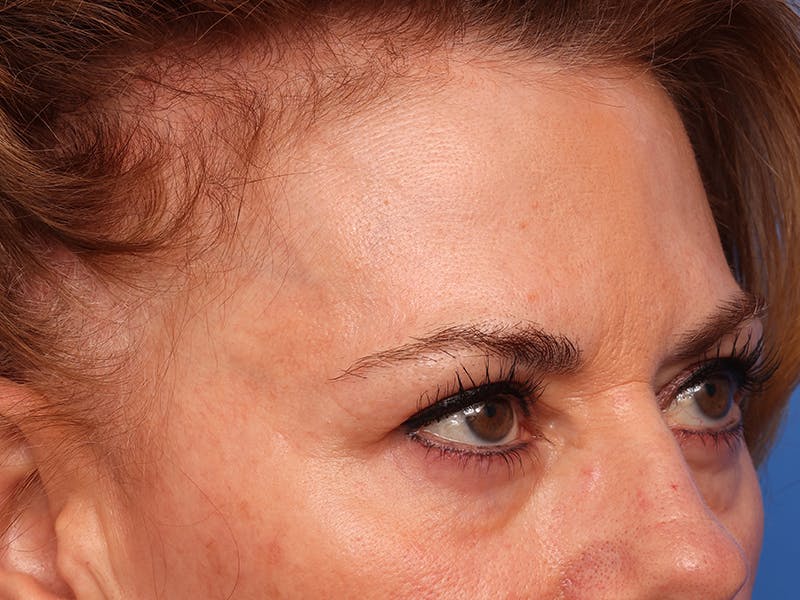 Brow Lift / Forehead Lift Before & After Gallery - Patient 496336 - Image 3