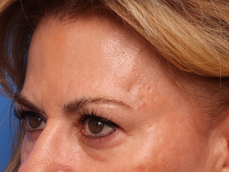 Brow Lift / Forehead Lift Before & After Gallery - Patient 496336 - Image 5