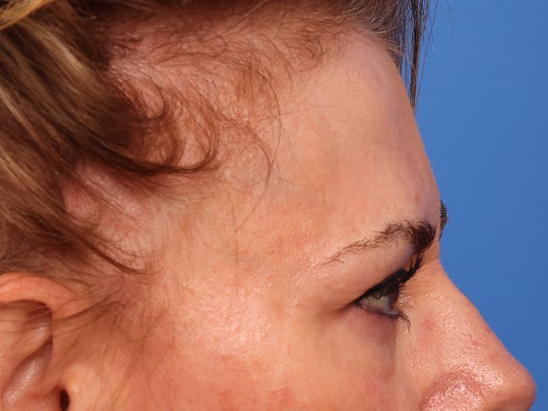 Brow Lift / Forehead Lift Before & After Gallery - Patient 496336 - Image 7