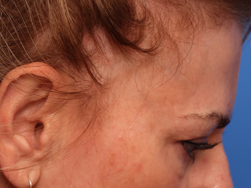 Brow Lift / Forehead Lift Before & After Gallery - Patient 496336 - Image 9