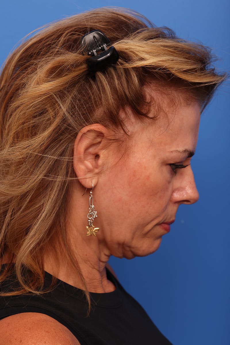 Neck Lift Before & After Gallery - Patient 171361 - Image 9
