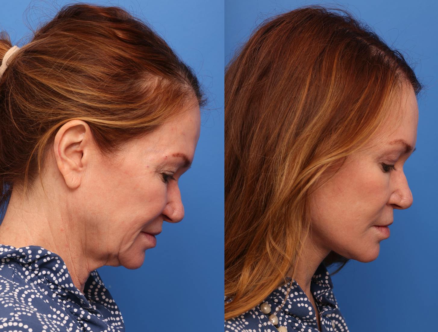 Deep Plane Facelift Before & After Gallery - Patient 264713 - Image 2