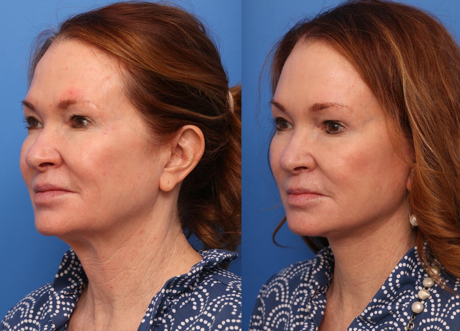 Deep Plane Facelift Before & After Gallery - Patient 264713 - Image 1