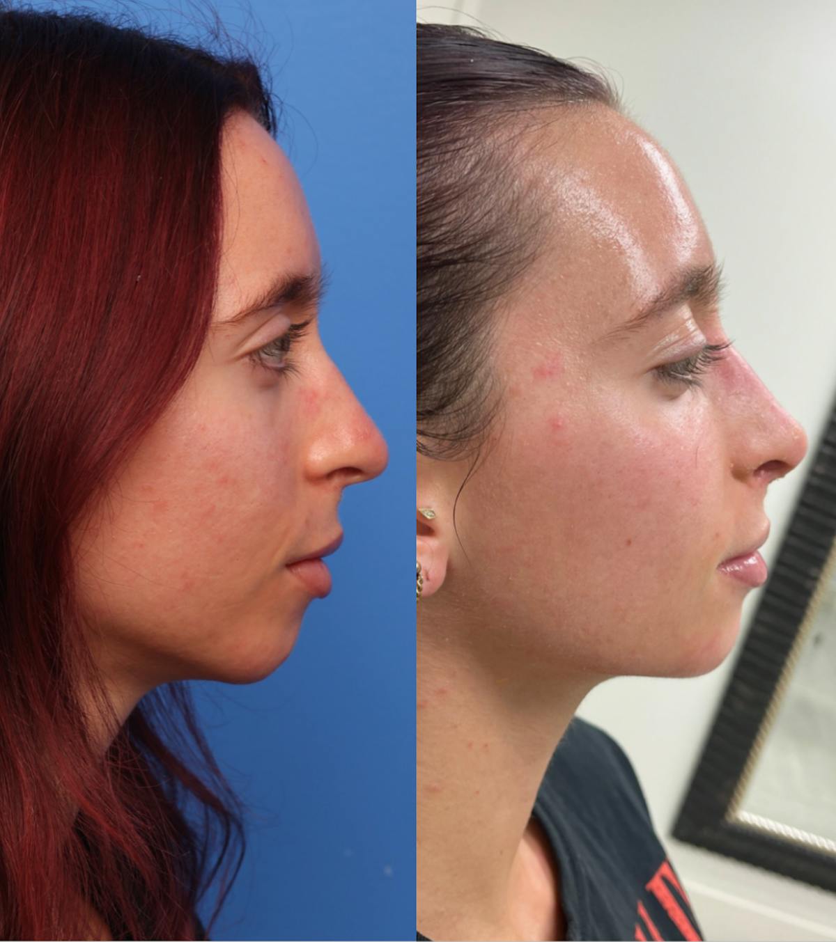 Rhinoplasty Before & After Gallery - Patient 146599 - Image 2