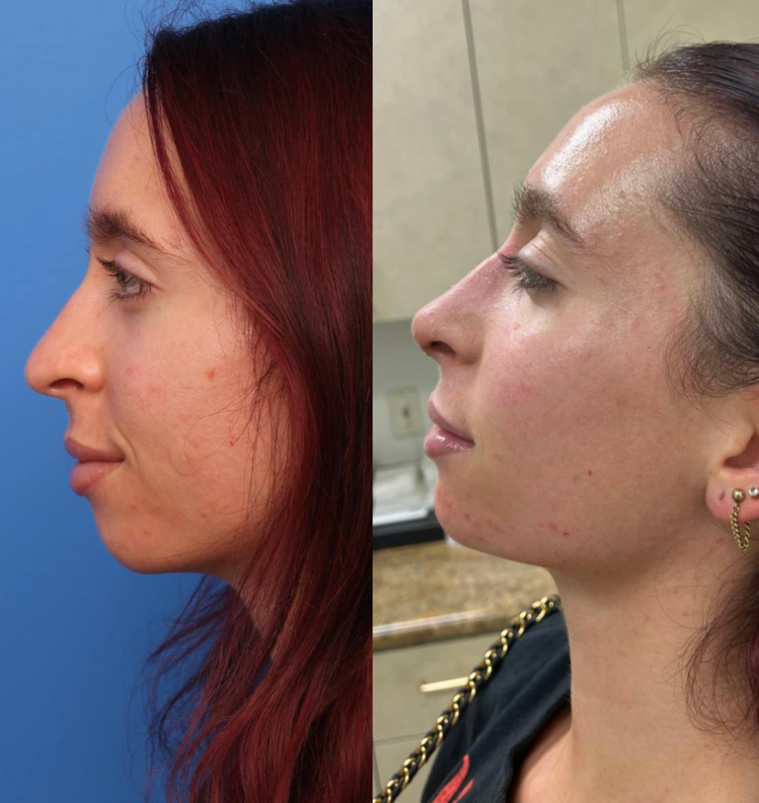 Rhinoplasty Before & After Gallery - Patient 146599 - Image 1