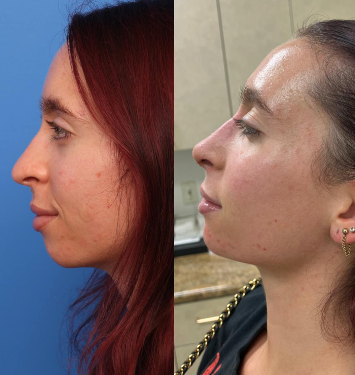 Rhinoplasty Before & After Gallery - Patient 146599 - Image 1