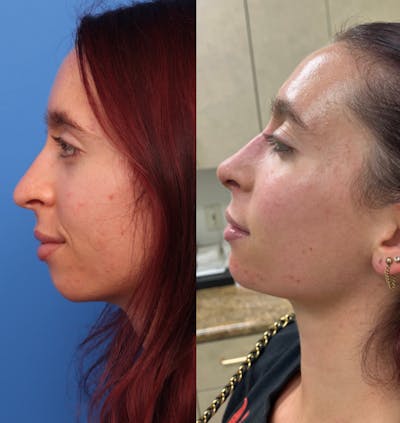 Rhinoplasty Before & After Gallery - Patient 146599 - Image 1