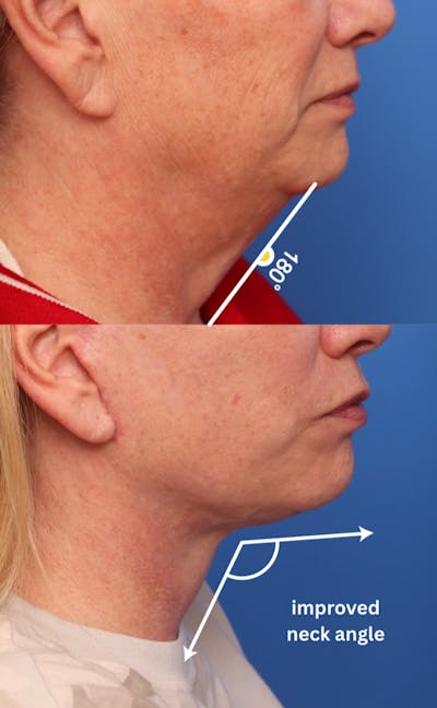 Deep Plane Facelift Before & After Gallery - Patient 222283 - Image 1