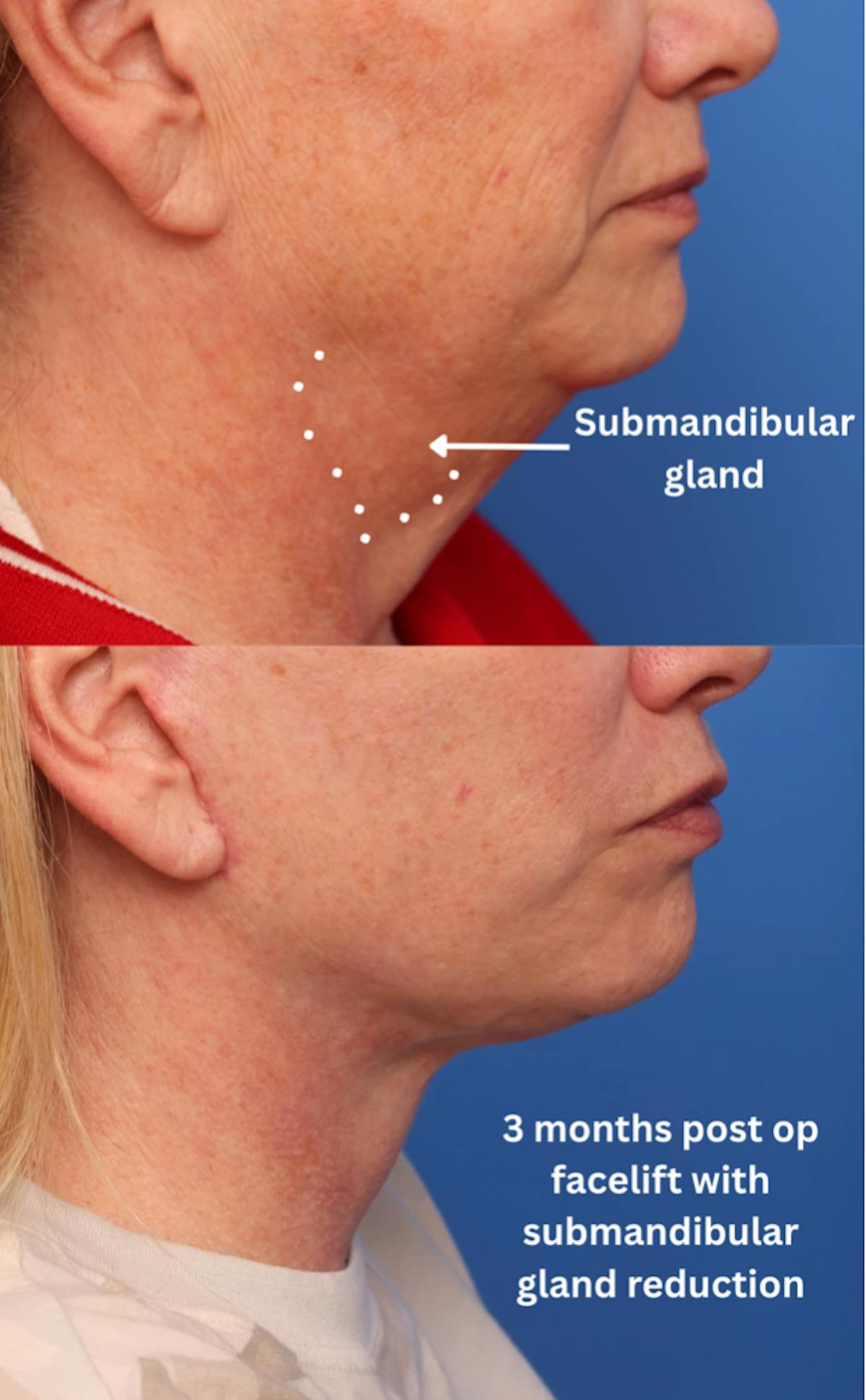 Deep Plane Facelift Before & After Gallery - Patient 222283 - Image 2