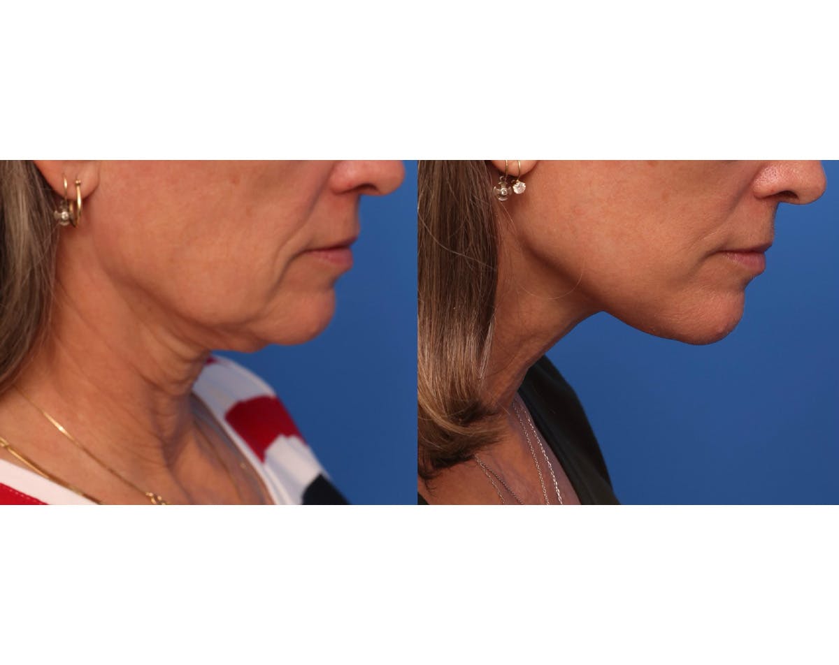 Neck Lift Before & After Gallery - Patient 163277 - Image 2
