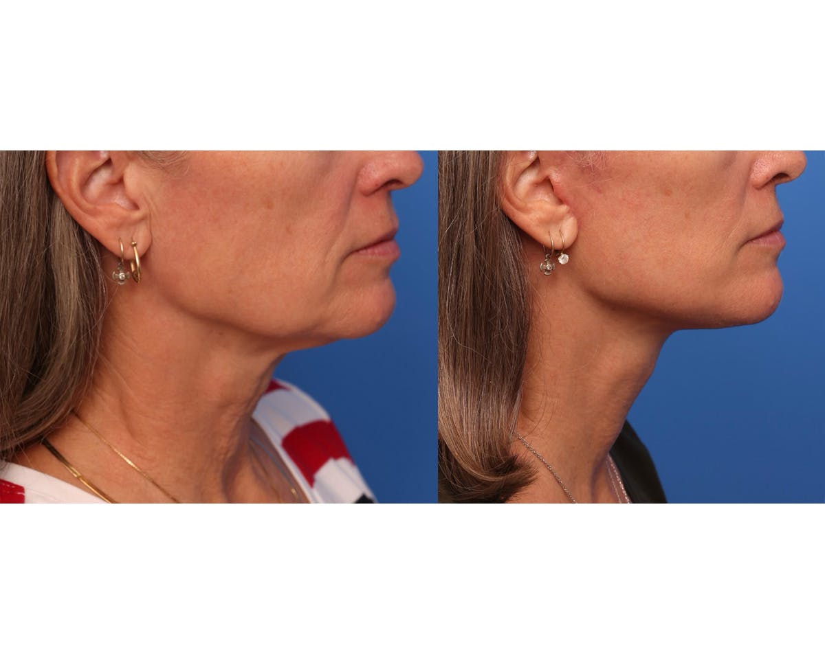Neck Lift Before & After Gallery - Patient 163277 - Image 1