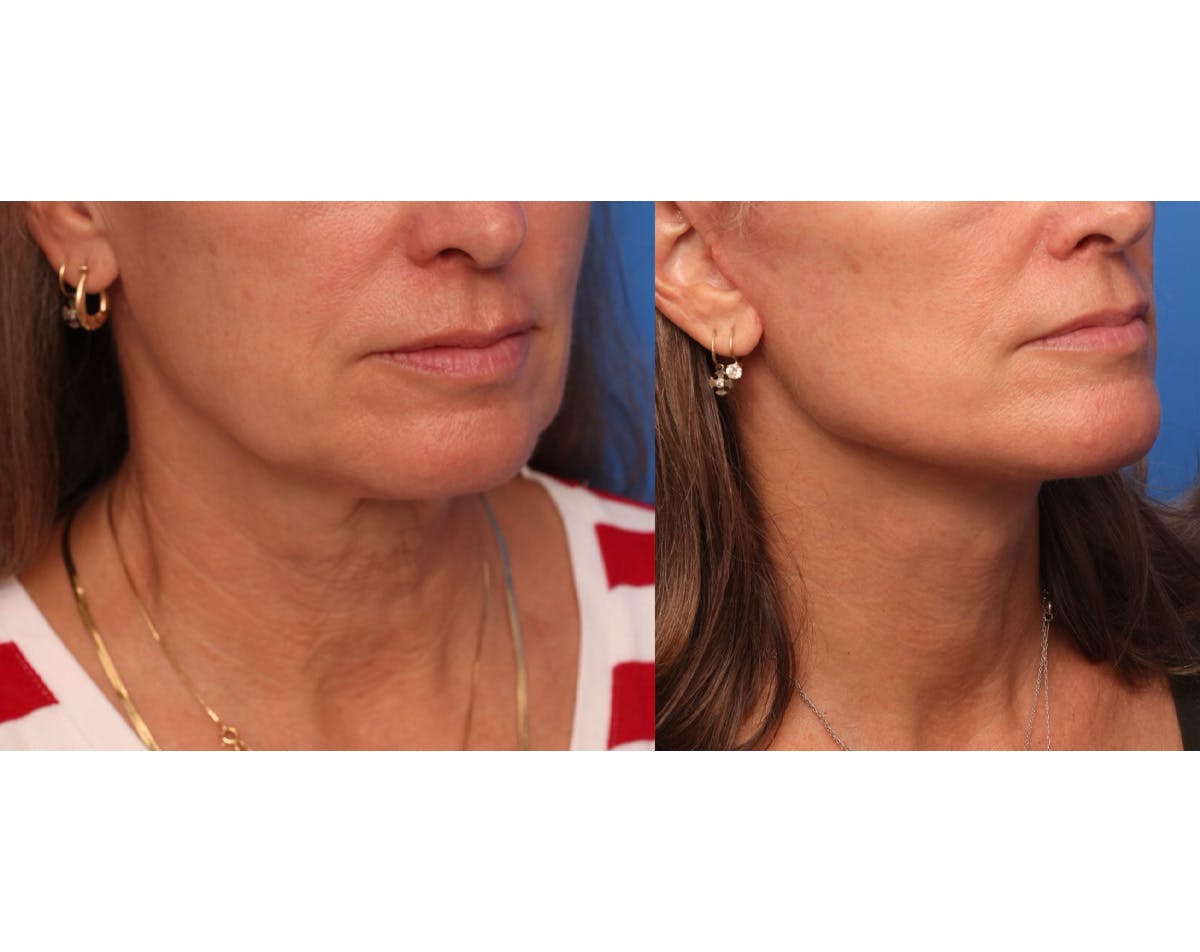 Neck Lift Before & After Gallery - Patient 163277 - Image 3
