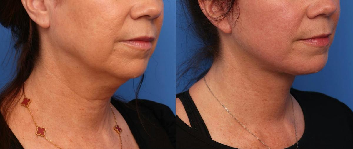 Deep Plane Facelift Before & After Gallery - Patient 219090 - Image 3