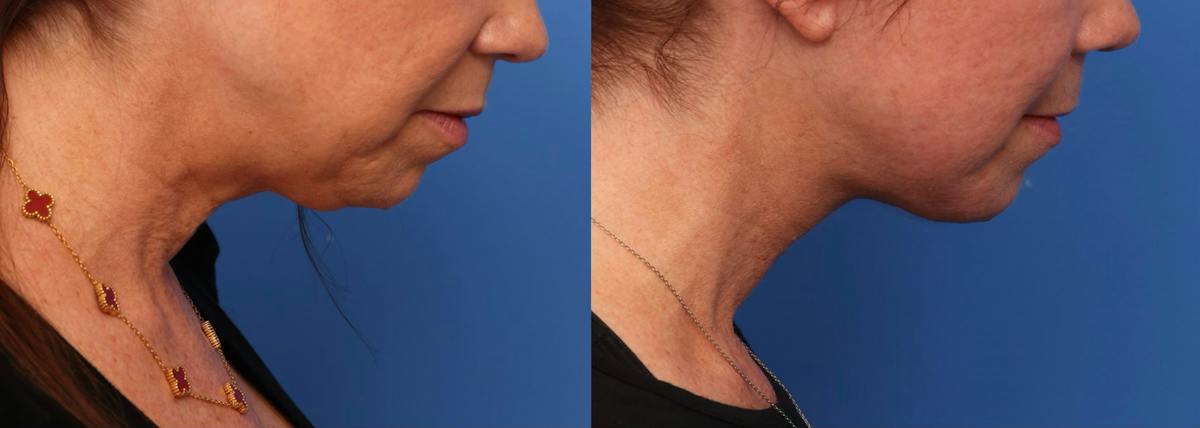 Deep Plane Facelift Before & After Gallery - Patient 219090 - Image 2