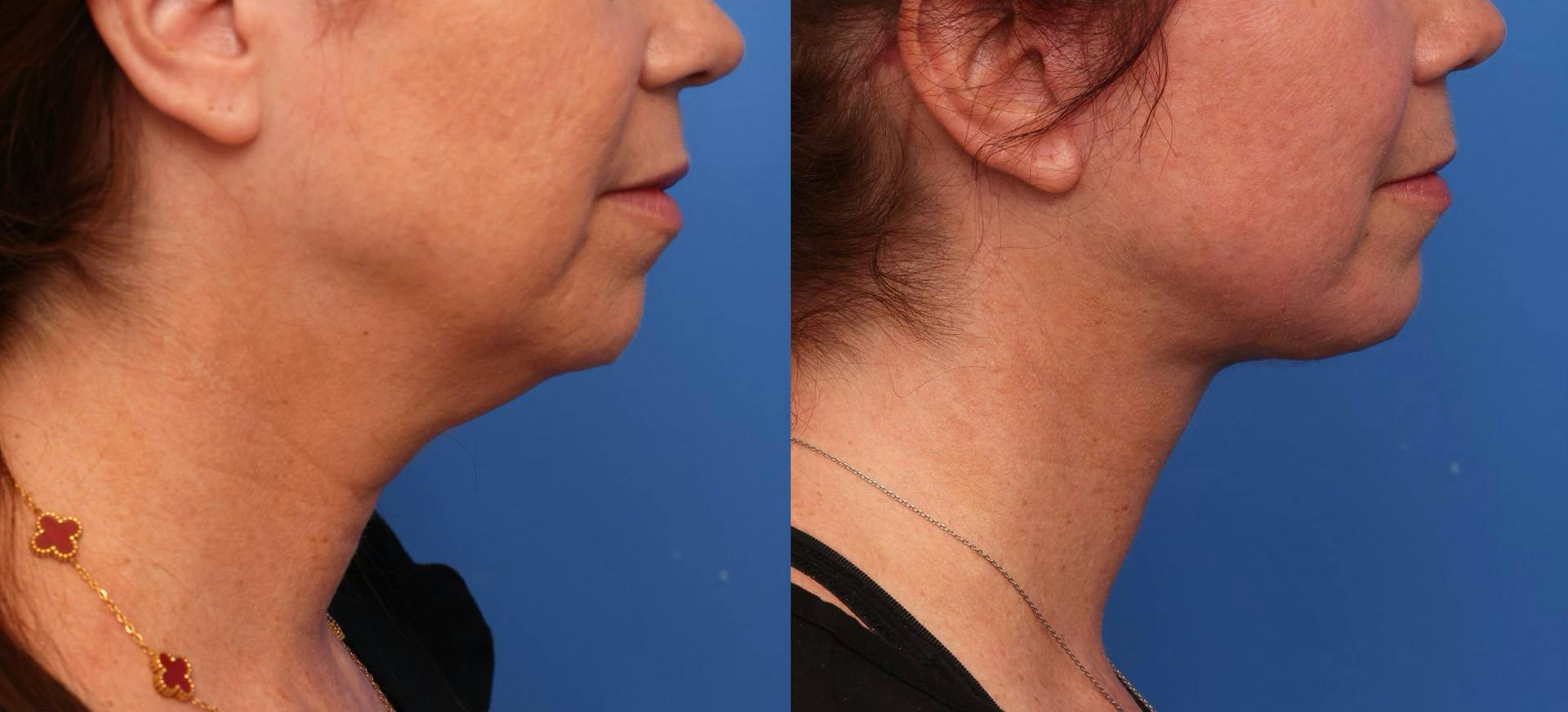 Deep Plane Facelift Before & After Gallery - Patient 219090 - Image 1