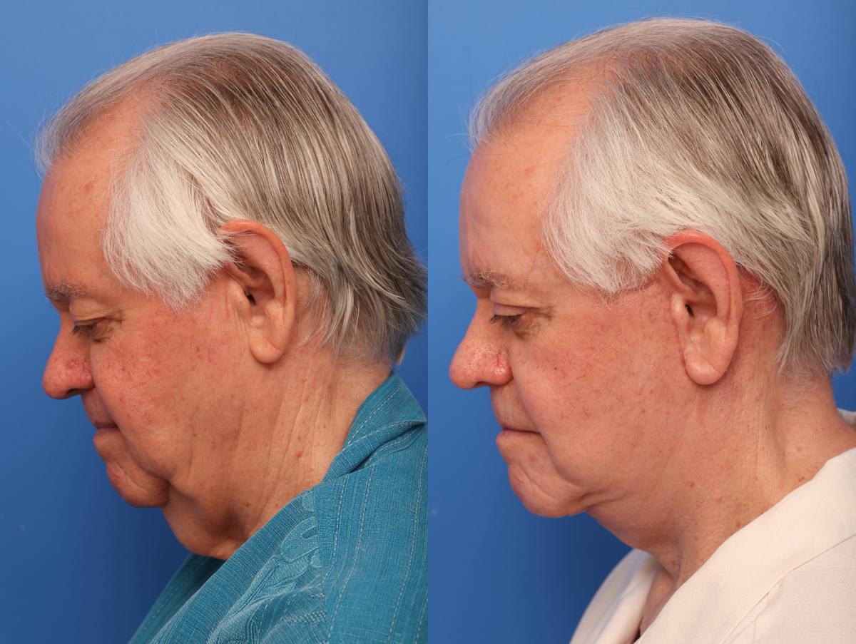 Neck Lift Before & After Gallery - Patient 252139 - Image 1