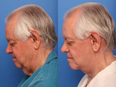 Neck Lift Before & After Gallery - Patient 252139 - Image 1