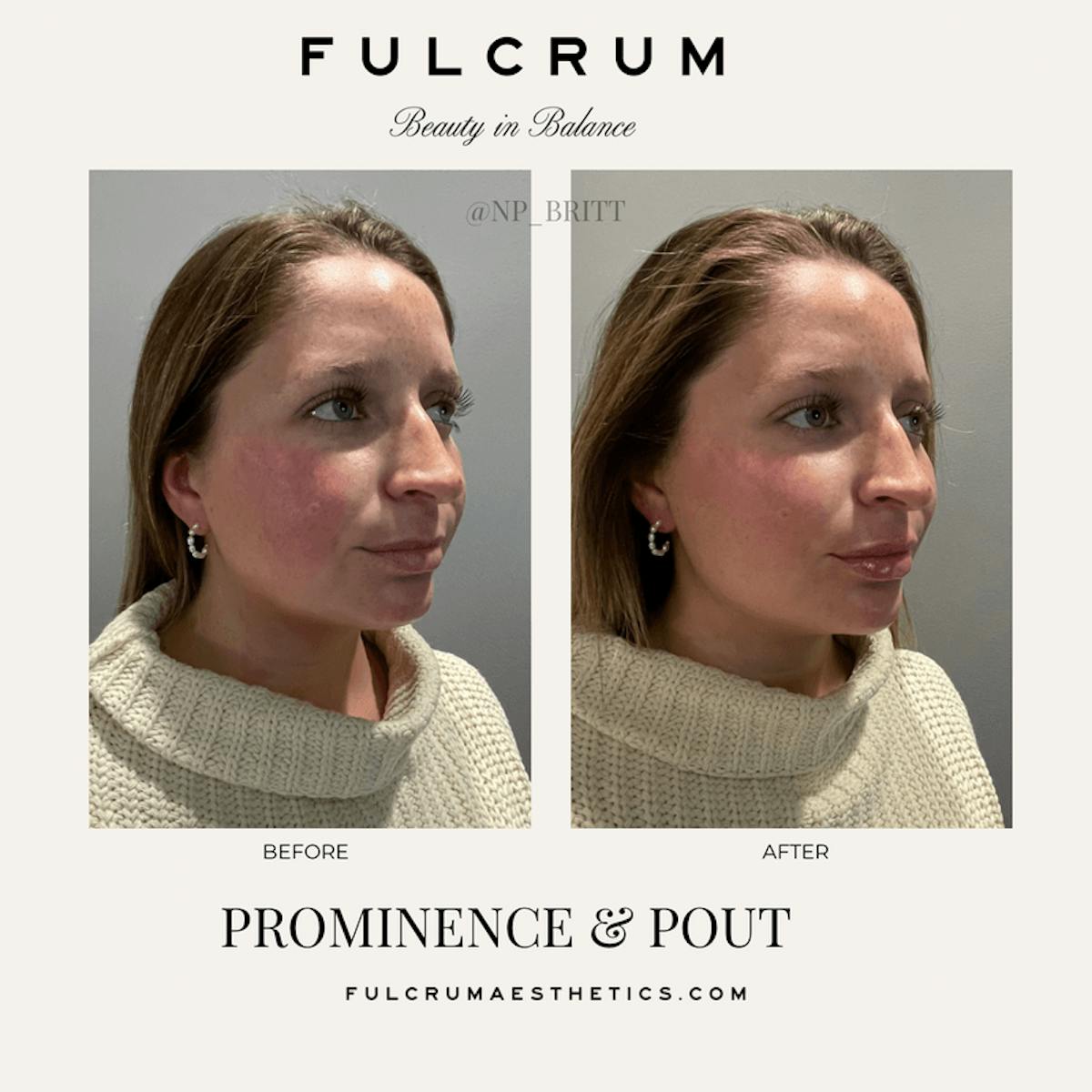Fillers Before & After Gallery - Patient 615586 - Image 1