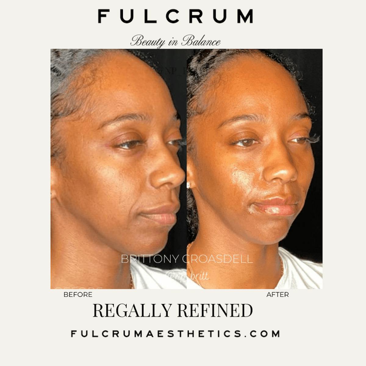 Fillers Before & After Gallery - Patient 253805 - Image 2