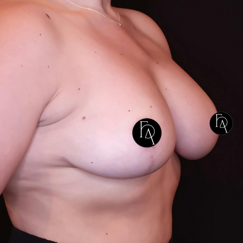 Woman's Breast