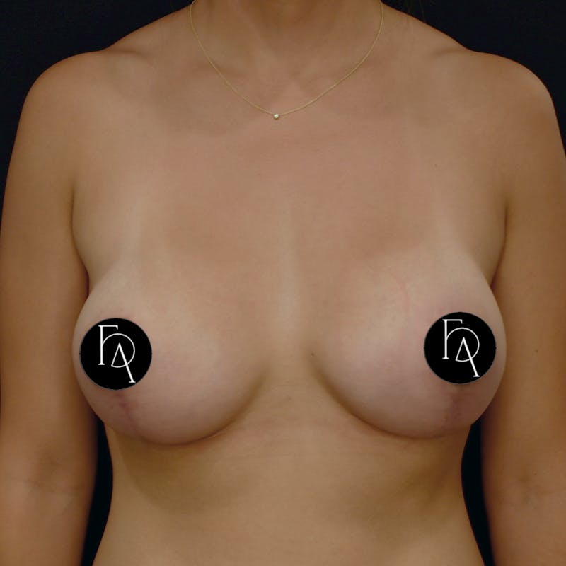 Breast Lift + Augmentation Before & After Gallery - Patient 350016 - Image 2