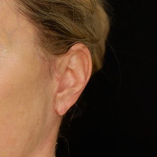 Deep Plane Facelift Before & After Gallery - Patient 302387 - Image 4
