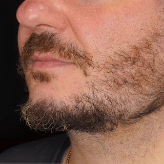 Deep Plane Facelift Before & After Gallery - Patient 195119 - Image 2